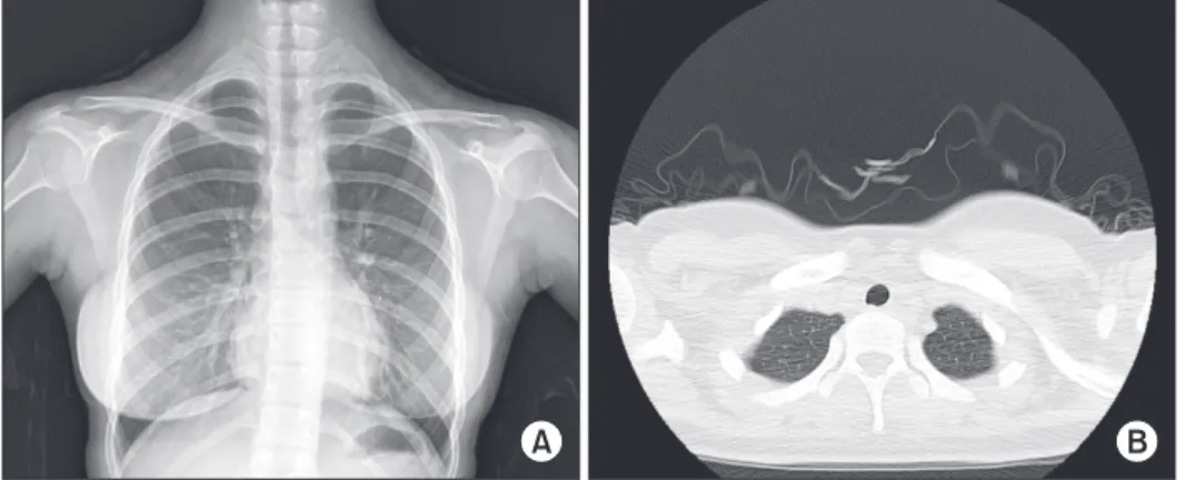 Fig. 3. Follow-up chest X-ray and com- com-puted tomography (CT) findings 10 days  later