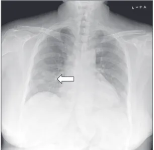 Fig. 1. Simple chest X-ray. It shows a mass (about 2.8×1.5 cm) in the  right middle lobe (arrow) suggesting malignancy.