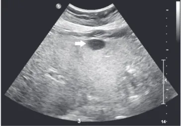 Fig. 3. Histologic findings. (A) Histologic findings of liver reveals diffuse macro- and microvesicular fatty change with moderate ballooning de- de-generation and moderate lobular activity (H &amp;E, ×100)