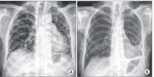 Fig. 1. Chest X-ray taken before lung  transplantation (LT) (A) and 7 days after  LT (B)