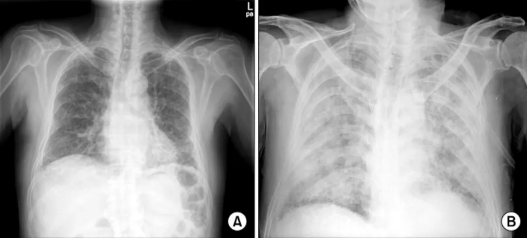 Fig. 3. (A) Initial chest x-ray shows  reticular  opacity  in  both lower lobes. (B) chest  x-ray after TACE shows  tr-anscatheter arterial  chemo-embolization  (TACE)   multi-focal bilateral patchy  grou-nd  glass  opacity.