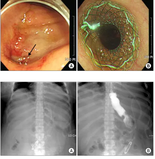 Fig. 4. Endoscopic finding after stent removal. The leak is completely  closed (arrow).