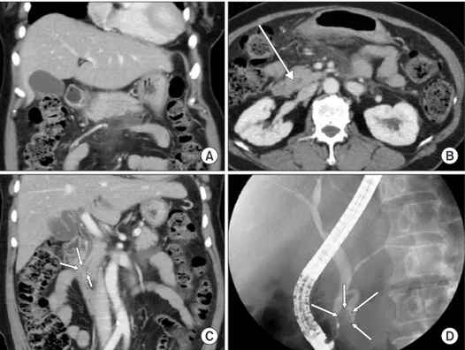 Fig. 1. Abdomen computed tomography  (CT) findings. (A) Diffuse parenchymal  swellling of pancreas, peripancreatic fatty  infiltration and fluid collection are seen