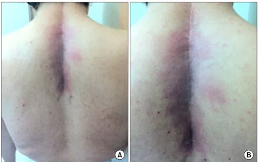 Fig. 1. (A) Erythema on upper back area  (previously irradiated area). (B)  Magnifica-tion of upper back area.