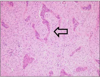 Fig. 4. Microscopic finding of excisional biopsy of the rib shows irregular  spindles  of  woven  bone  (characteristic  chinese  letter,  arrow)  without  osteoblastic  rimming  and  a  proliferation  of  fibroblast  consistent  with  fibrous  dysplasia  
