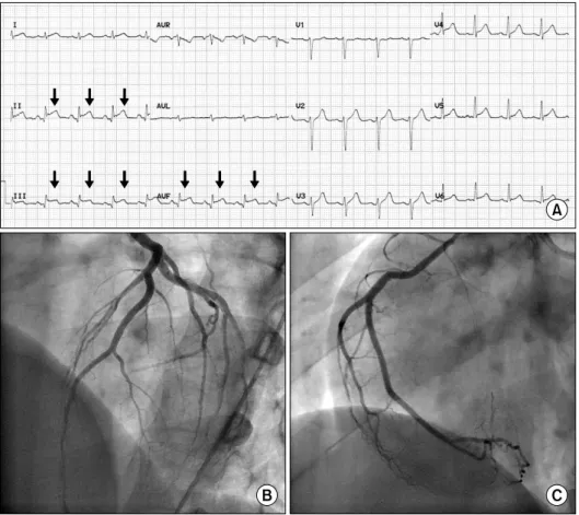 Fig. 1. Electrocardiography and coronary angiography data. Q waves and ST  seg-ment  elevation  are   indi-cated by arrows (A)