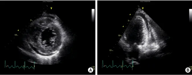 Fig.  4.  Two-dimensional  echocardiography  at  day  2  showing  diffuse  hypokinesis  of  left  ventricle  with  severe  systolic  dysfunction