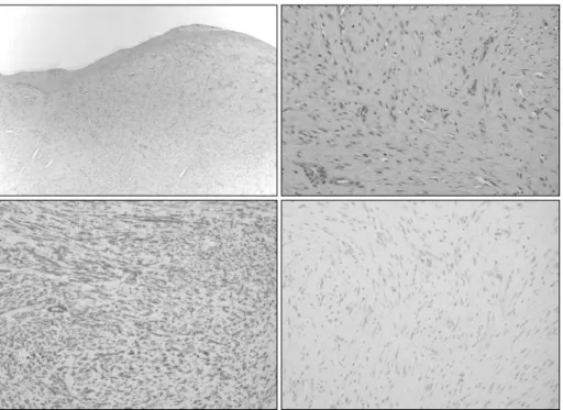 Fig. 4. Pathologic finding(Above Left H&amp;E：×40, Above Right H&amp;E：×200). Leiomyoma, capsulated lesion com- com-posed of elongated cell white monomorphic cigar shaped nuclei(Below Left Actin：×200, Below Right S-100：×