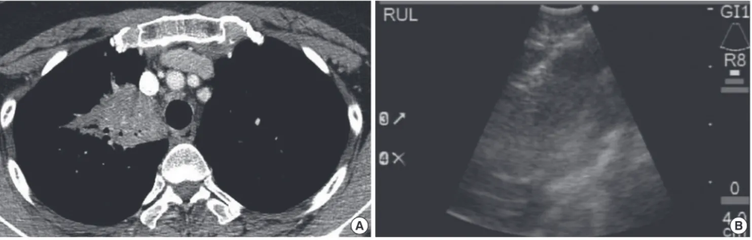 Fig. 3. CP-EBUS-TBNA for the central parenchymal lung mass. (A) Lung parenchymal mass at right upper lobe which abuts the trachea