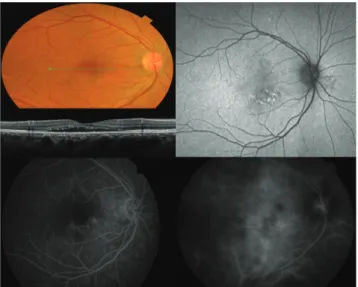 Fig. 1. Representative case of acute central serous 