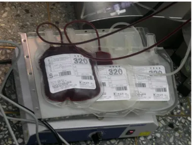 Fig. 1. Autologous blood extracted during the perioperative  state as shown is contained in the transfusion bag.