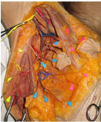 Fig. 1. Cadaver  dissection  shows  three  groups  of  perforator  in  axilla  area.  First  rows(yellow)  indicate  musculotaneous  perforator group,  mid  rows(blue)  indicate  septocutaneous  perforator  group  and  the  other  anterior  rows(pink)  ind