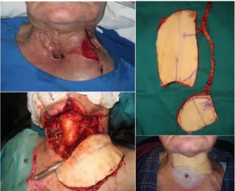 Fig. 4.  (Above,  Left)  Recurrent  MRSA  infection  of  artificial  dura  and  cerebritis  (Above,  Right)  Intraoperative  view  of  cranium  (Below,  Left)  Vastus  Lateralis  perforator  flap  which  is  known  as  anterolateral  thigh  perforator  fla