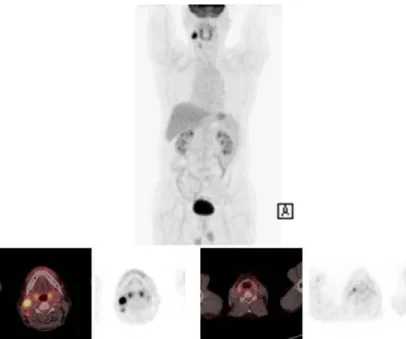 Fig. 3. Metastatic  squamous  cell  carcinoma  of  right  cervical  lymphadenopathy  with  unknown  primary  tumor