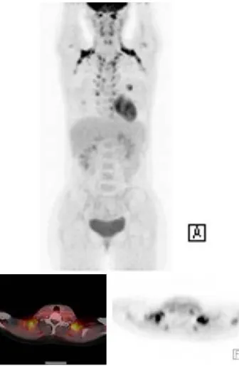 Fig. 5. Physiologic  brown  fat  activity  in  bilateral  neck  should  not  be  misinterpreted  as  pathologic  cervical  lymph  nodes.