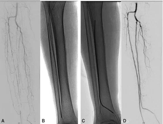 Fig. 1. A) Initial angiogram shows stenoocclusive lesions of infrapopliteal arteries. B, C)