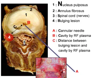 Fig. 1 Schematic showing of the percutaneous lumbar disc nucleoplasty using conventional straight cannular needle injection into L4-L5