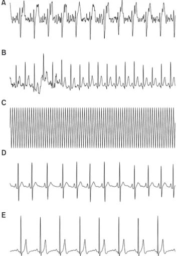 Figure 1.  Acceptable and non-acceptable electrocardiogram (ECG)  examples. Non-acceptable ECGs have global (A) or local  (B) noise, or signals from ECG equipment rather than  patients (C)
