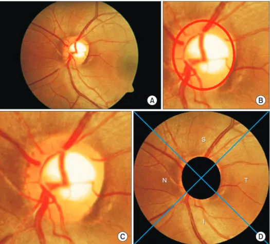 Figure 3.   Original image and the  results of region of  inter-est (ROI) detection: (A)  retinal fundus image, (B)  boundary of optic nerve  head (ONH), (C) updated  position of ONH, and (D)  ROI image with sector  di-vision.