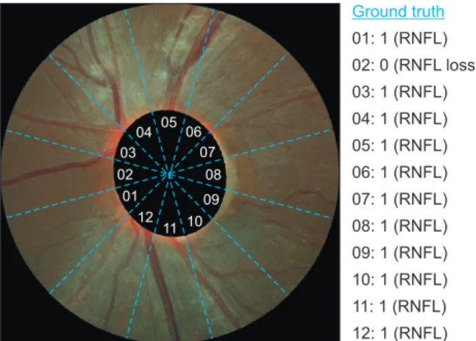 Figure 6.  Partition of sectors into sub-sectors and the ground  truth. RNFL: retinal nerve fiber layer.