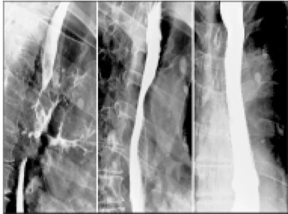 Fig. 4. Determination of stenting area in cases of ERF. Left one is before stenting. Right one is after stenting.