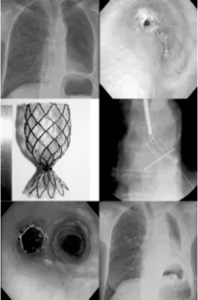 Fig. 7. Occluder stent was inserted to seal-off bron- bron-chopleural fistula (BPF) after left pneumonect- omy.