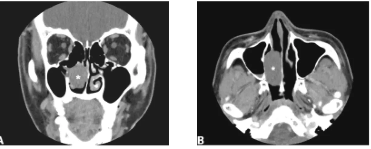 Fig. 1. Paranasal sinuses CT scan of the case.