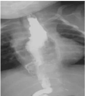 Fig. 2. Postoperative esophagogram shows no leakage and stenosis at anastomotic site.