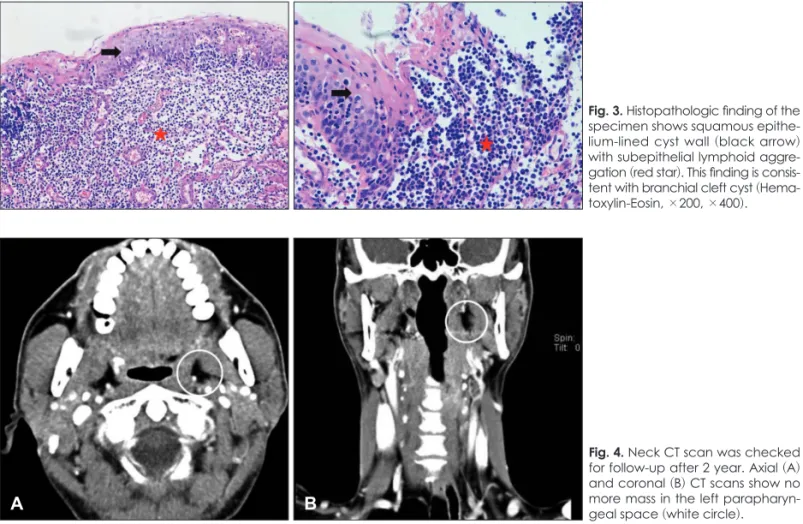 Fig. 3. Histopathologic finding of the  specimen shows squamous  epithe-lium-lined cyst wall (black arrow)  with subepithelial lymphoid  aggre-gation (red star)