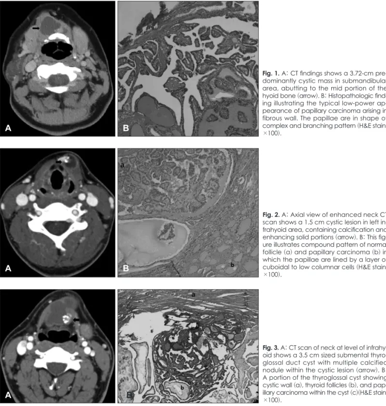 Fig. 1. A: CT findings shows a 3.72-cm pre- pre-dominantly cystic mass in submandibular  area, abutting to the mid portion of the  hyoid bone (arrow)