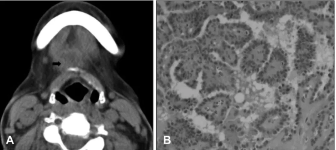Fig. 4. A: CT image reveals a 1.5 cm central  low density mass lesion in prehyoid area  (arrow)