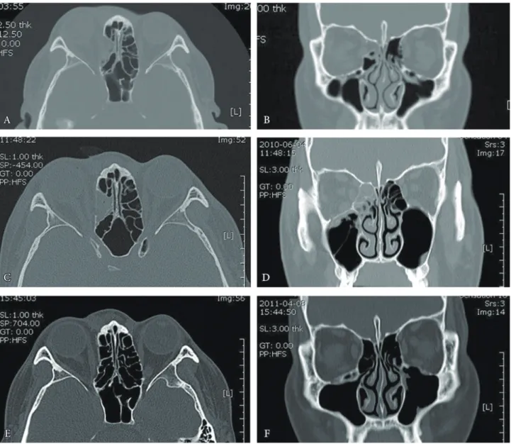 Fig. 3. (A) A preoperative axial computed tomography (CT) scan of a 27-year-old man shows pure medial orbital wall fracture with soft tissue  herniation