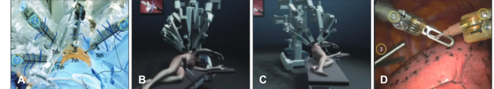 Fig. 1. Port placement for robot-assisted pulmonary resection. (A) Port placement. (B) Cart approach (anterior view), (C) Cart ap- ap-proach (foot view), (D) Three instruments in the thoracic cavity.