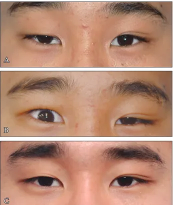 Fig. 2. Case. (A) A 29-year-old man has right sided blepharoptosis  based on the preoperative photography