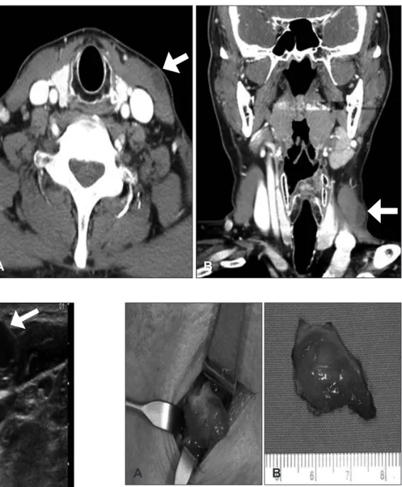 Fig. 1. Computerized tomography  scan demonstrates a small non  enhancing nodule at the anterior  aspect of left sternocleidomastoid  muscle (arrow)