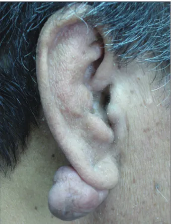 Fig. 1. Preoperative view of the patient; spontaneous right earlobe  keloid in a 68-year-old male