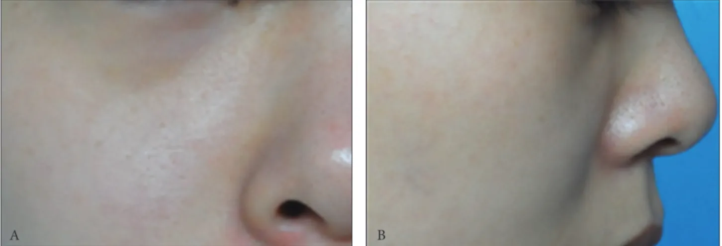 Fig. 2.  Facial computed tomography. 13 × 10 × 5 mm sized oval shaped soft tissue neoplasm (arrows) can be identified in the right infraorbital  region