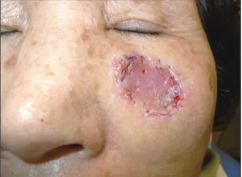 Fig. 4. At postoperative 14 days, full-thickness skin graft was well taken.