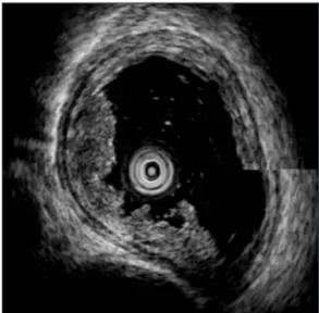 Fig. 3. An examples of esophageal cancer infiltrated into sub- sub-mucosa. Destruction of mucosa and submucosa caused by  in-filtration of the cancer is observed in the direction of 6-10 o’clock.