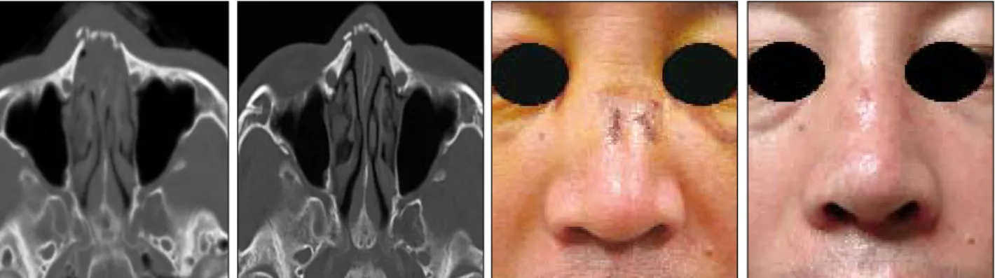 Fig. 5. Difficult case of nasal bone fracture: Unilateral Nasal bone fracture expecting delayed nasal bony deviation