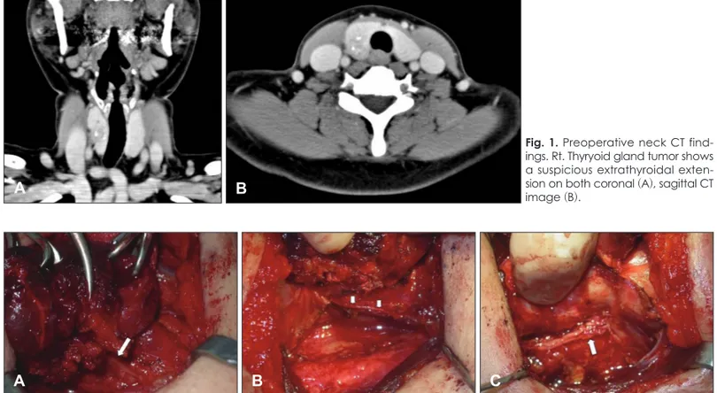 Fig. 1. Preoperative neck CT find- find-ings. Rt. Thyryoid gland tumor shows  a suspicious extrathyroidal  exten-sion on both coronal (A), sagittal CT  image (B).