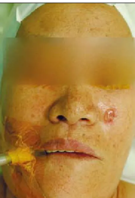 Fig. 2. (Above, left) Dissected flap after the total  resection of the basal cell carcinoma