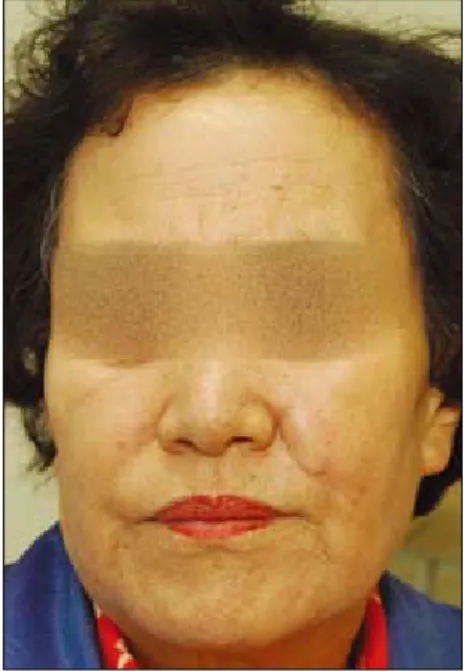Fig. 4. Postoperative frontal view (6th months).