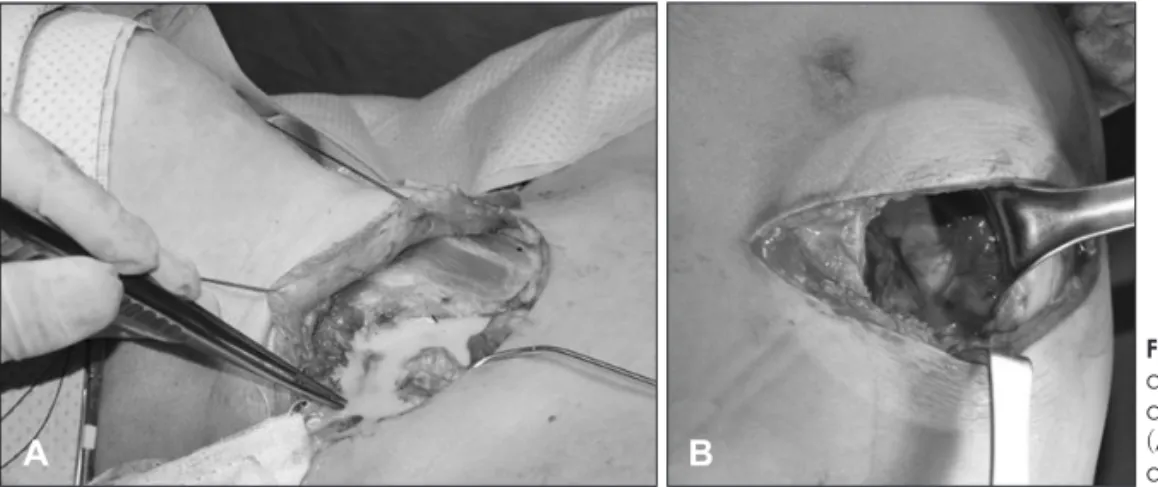 Fig. 2. Intraoperative findings. A large  quantity of pus are drained through  an anterolateral cervical approach  (A) and posterolateral thoracotomy  approach (B).