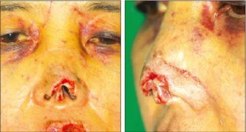 Fig. 2. The intraoperative view. (Left) The lelveted forehead flap has three layered structure