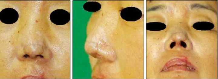 Fig. 3. The postoperative view at 6 months shows well defined nasal tip and thin flap without deformity or contracture