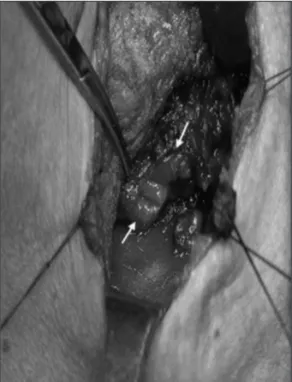 Fig. 4. Intraoperative finding. A perforation 2 cm in diameter  (white arrow) is present in the right pyriform sinus.