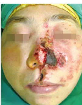 Fig. 2. Postoperative view of full-thickness-skin-graft. Thirteen days  after debridement.