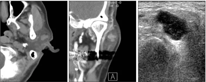 Fig. 1. (Left) Axial computed tomography (CT) showed a solid mass in superficial lobe of the left parotid gland