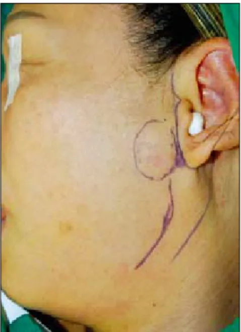 Fig. 4. The tumor was composed of basaloid cells with variable sized  tubular structures (H&amp;E, ×100).